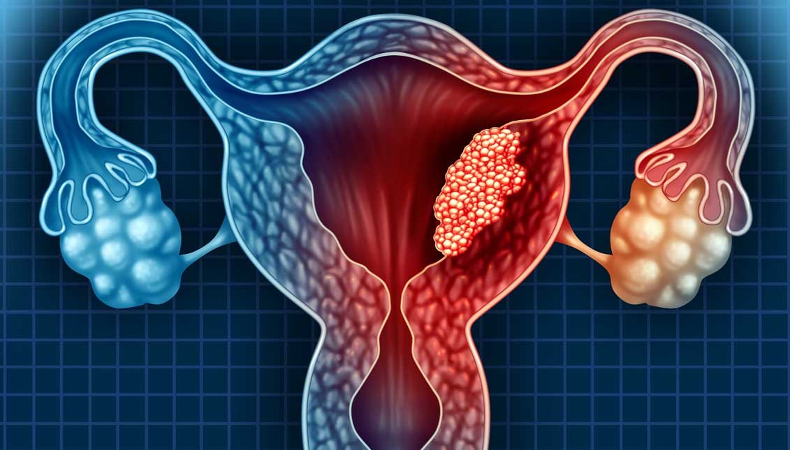 El cáncer de cuello uterino y cómo prevenirlo